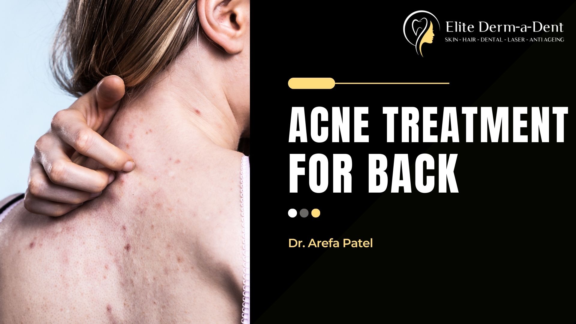 Back Acne (“Bacne”): Symptoms, Causes & Treatment