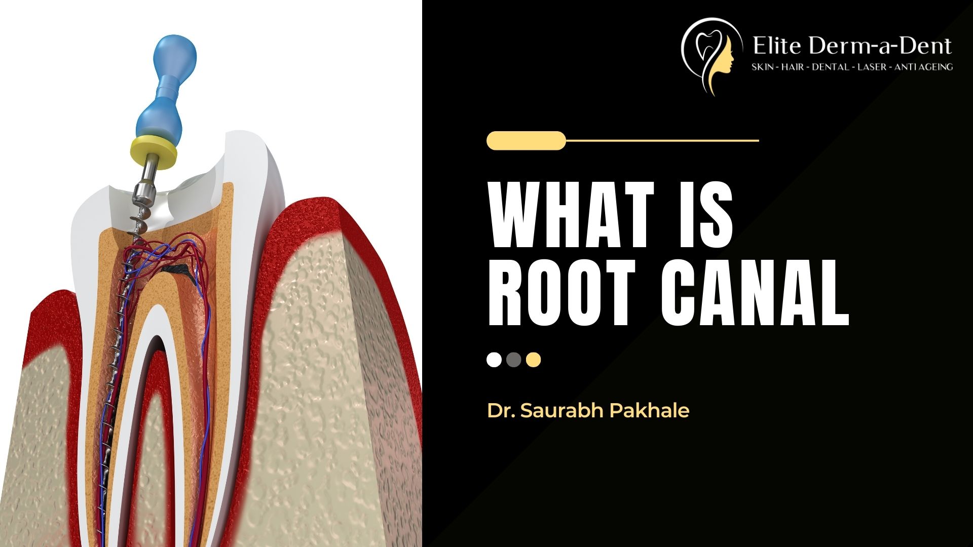 Dr. Saurabh Pakhale Explains What is Root Canal