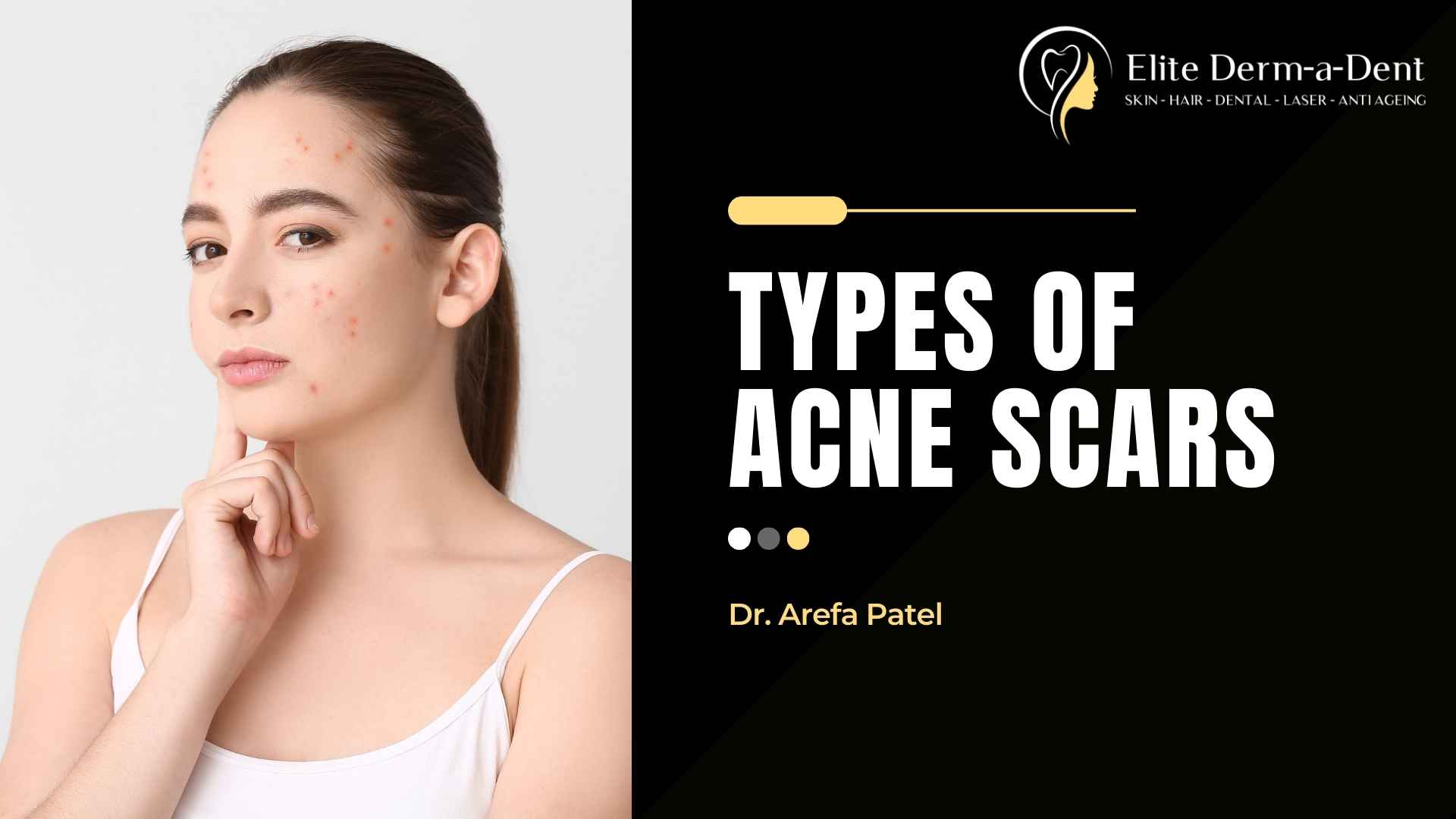 Types of Acne Scars