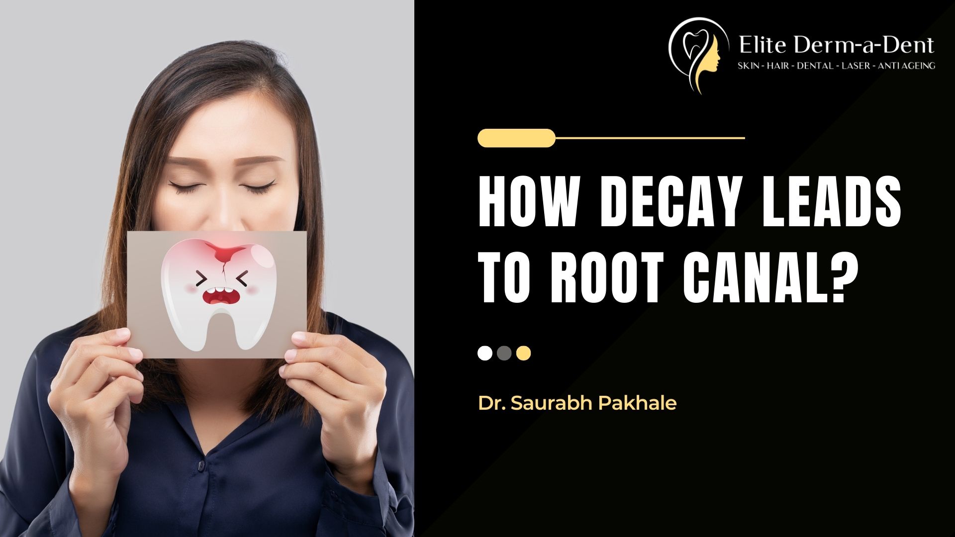 How Decay Leads to Root Canal