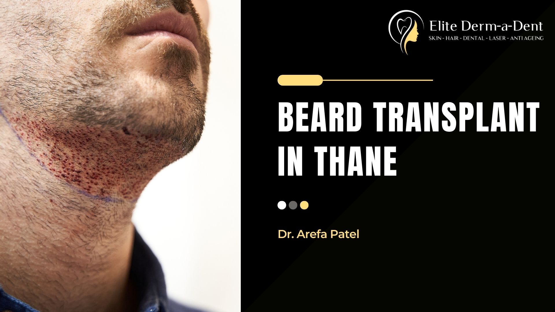 Beard Transplant in Thane