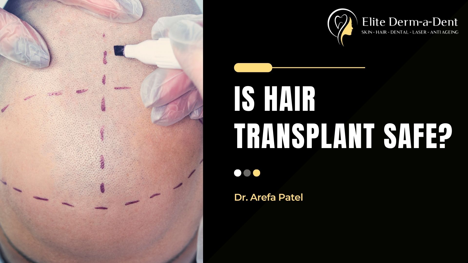 Is Hair Transplant Safe