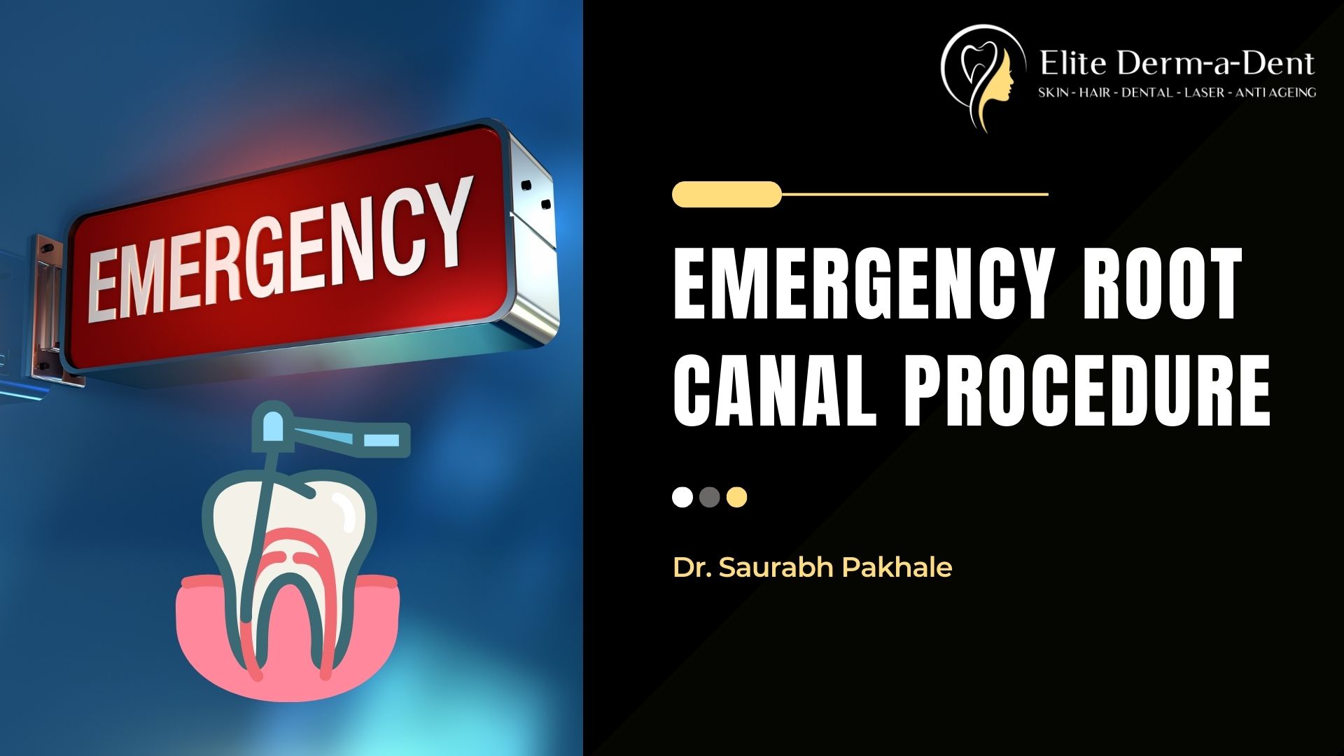 Emergency Root Canal Procedure