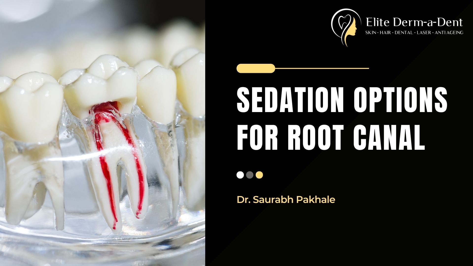 Sedation Options for Root Canal Treatments