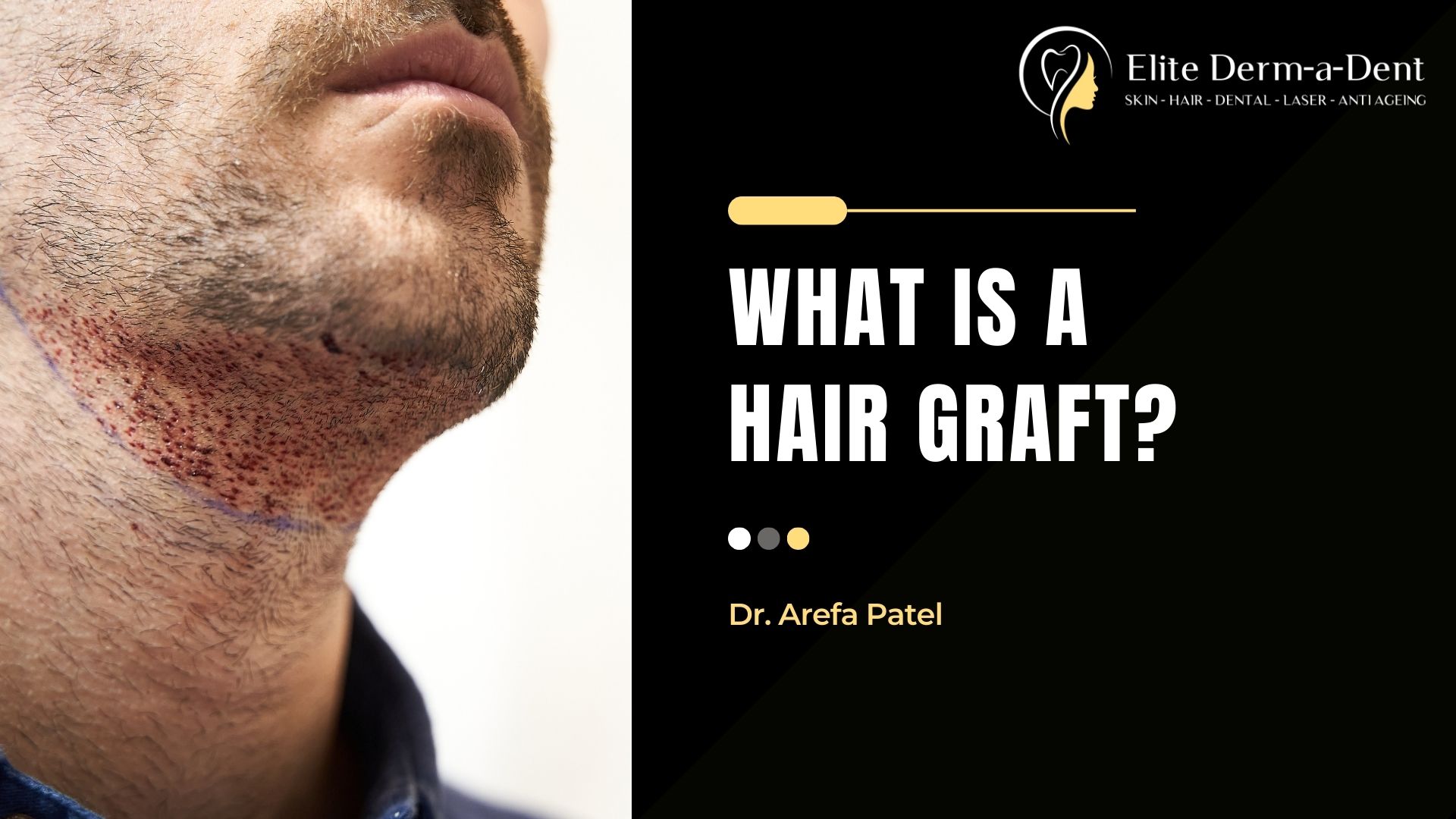 What is a Hair Graft