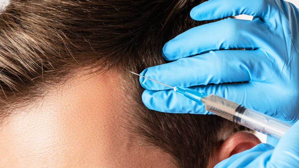 Comparing PRP to Other Hair Loss Treatments