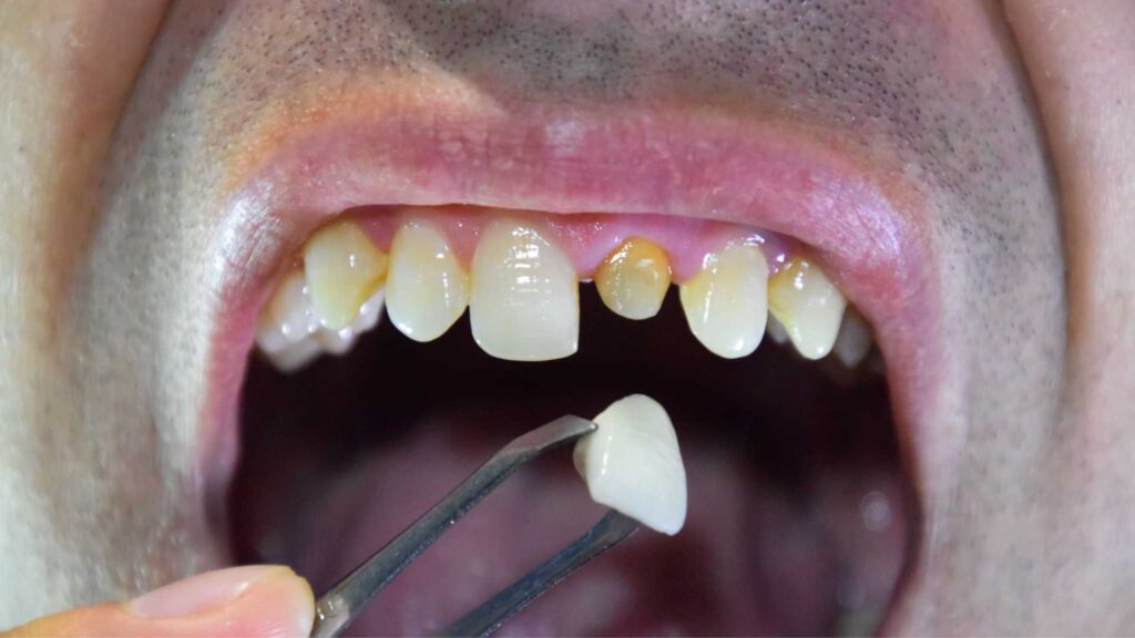 Why Choose Elite Dermadent for Dental Crowns