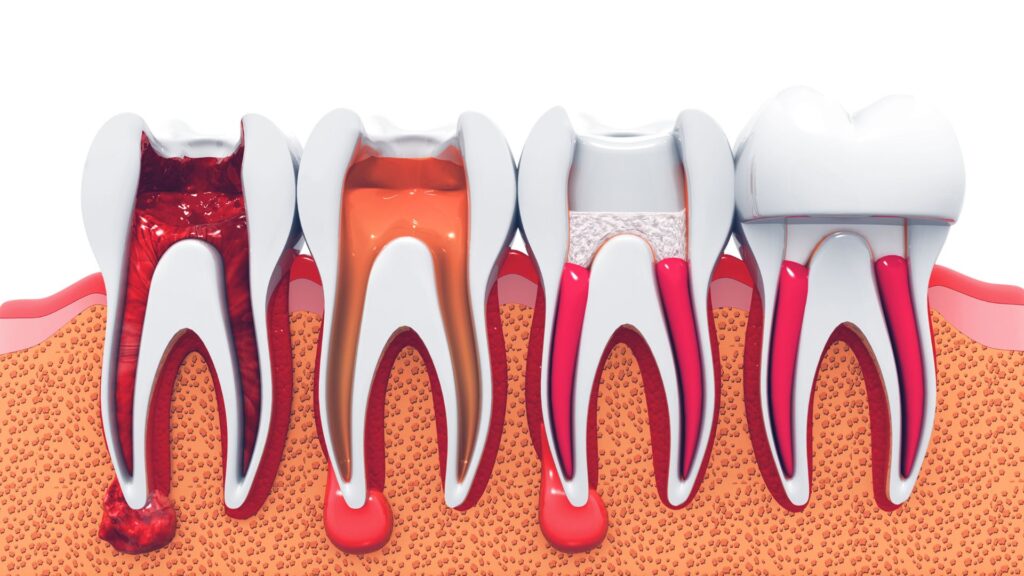 Reasons for Root Canal Retreatment
