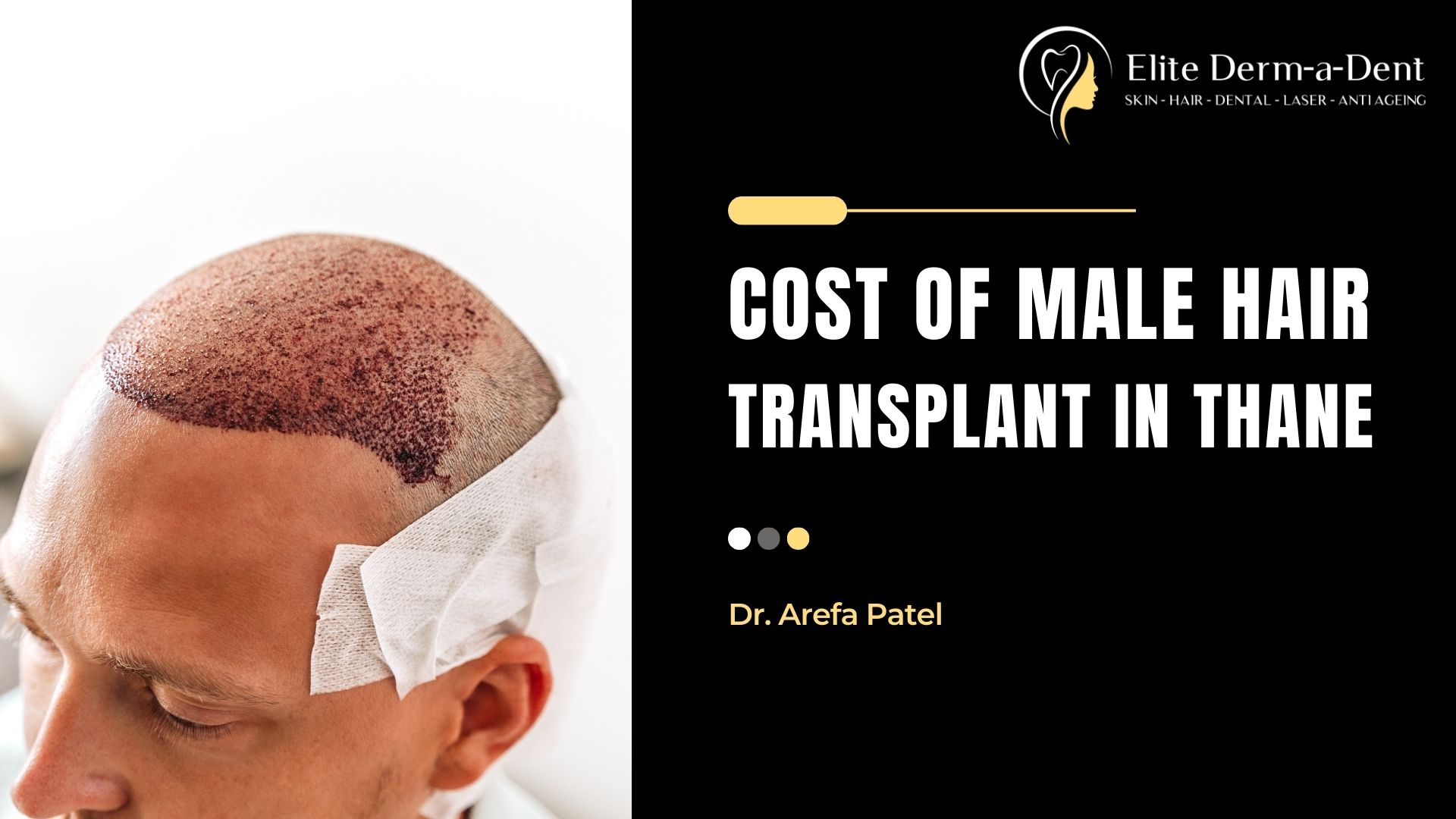 cost of male hair transplant in thane