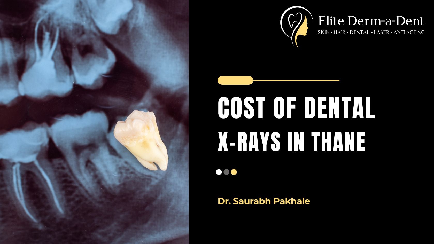 Cost of Dental X-Rays in Thane