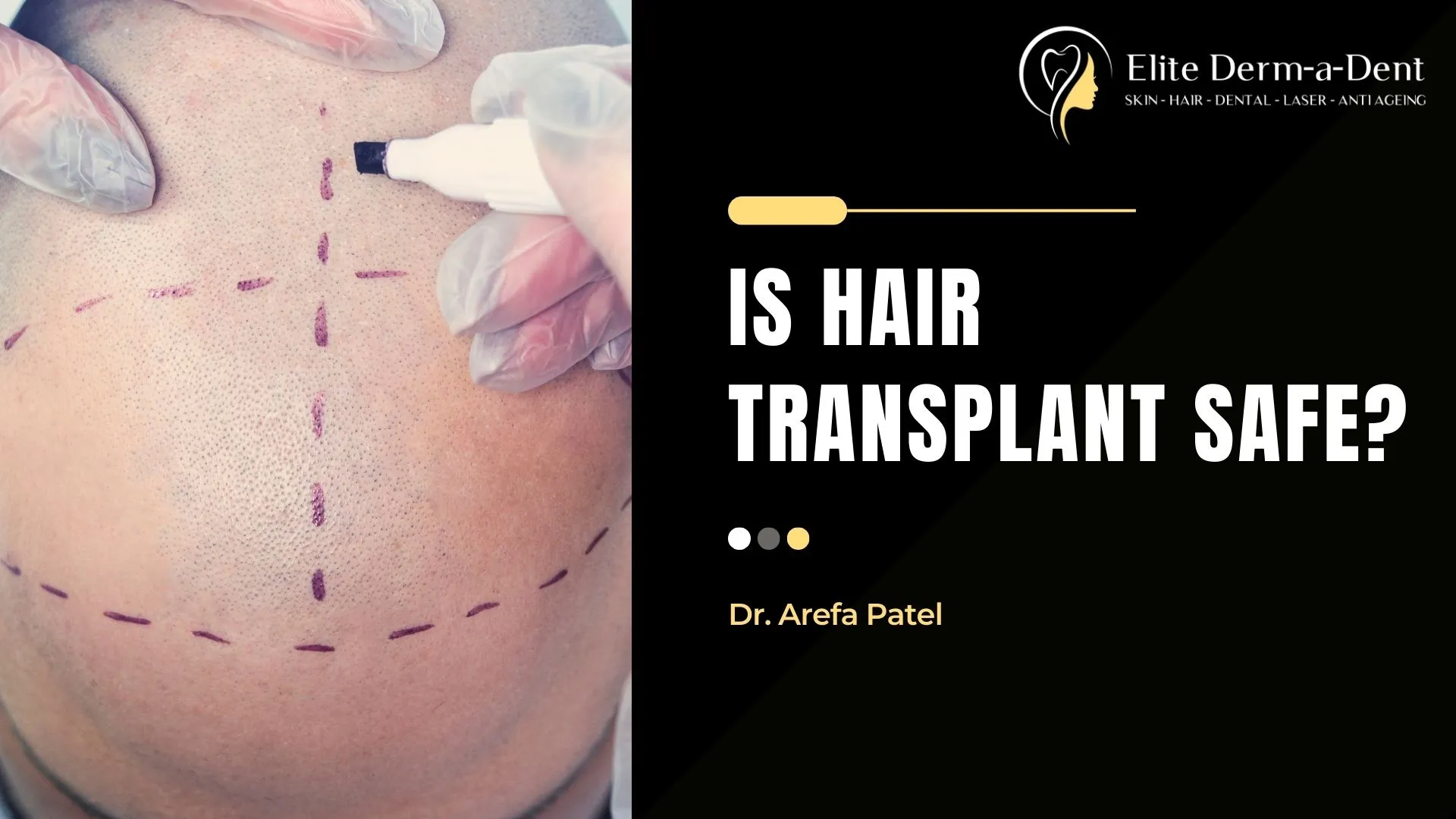 Is Hair Transplant Safe? (2025) | Dr. Arefa Patel