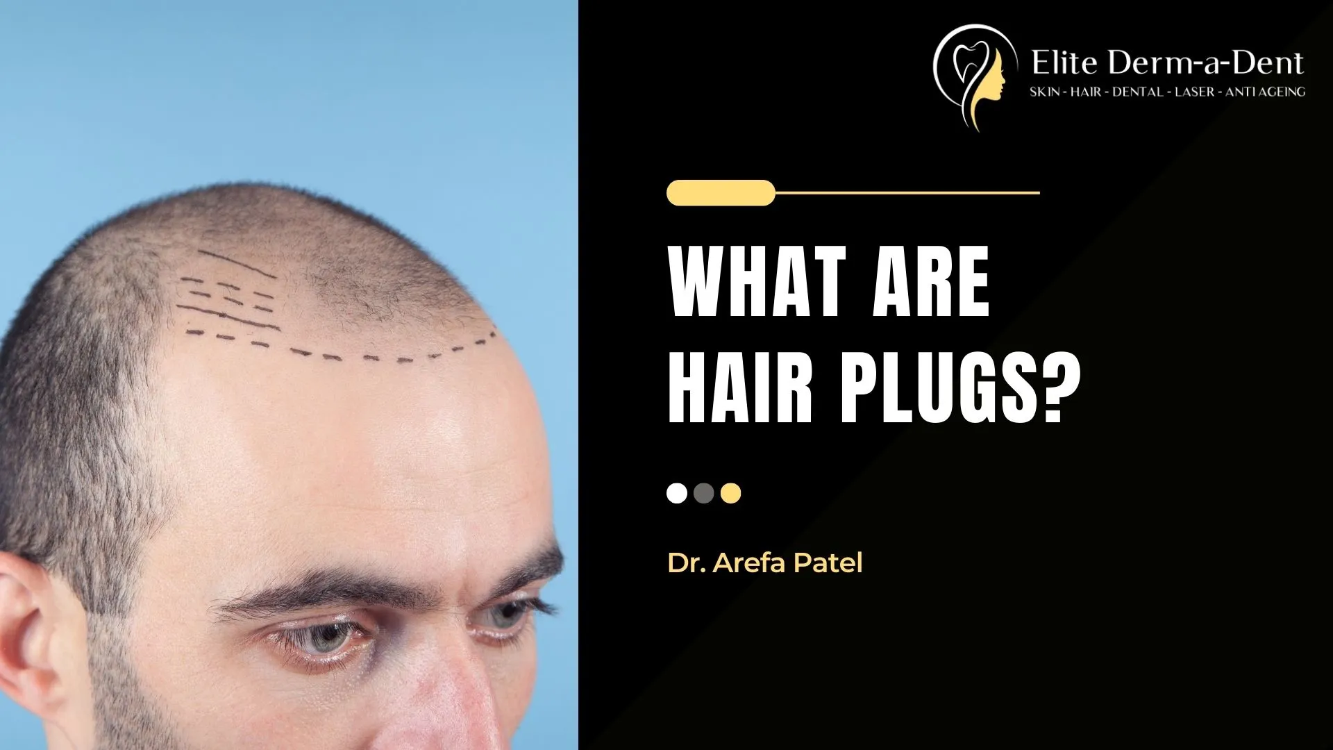What are Hair Plugs? (2025) | Dr. Arefa Patel