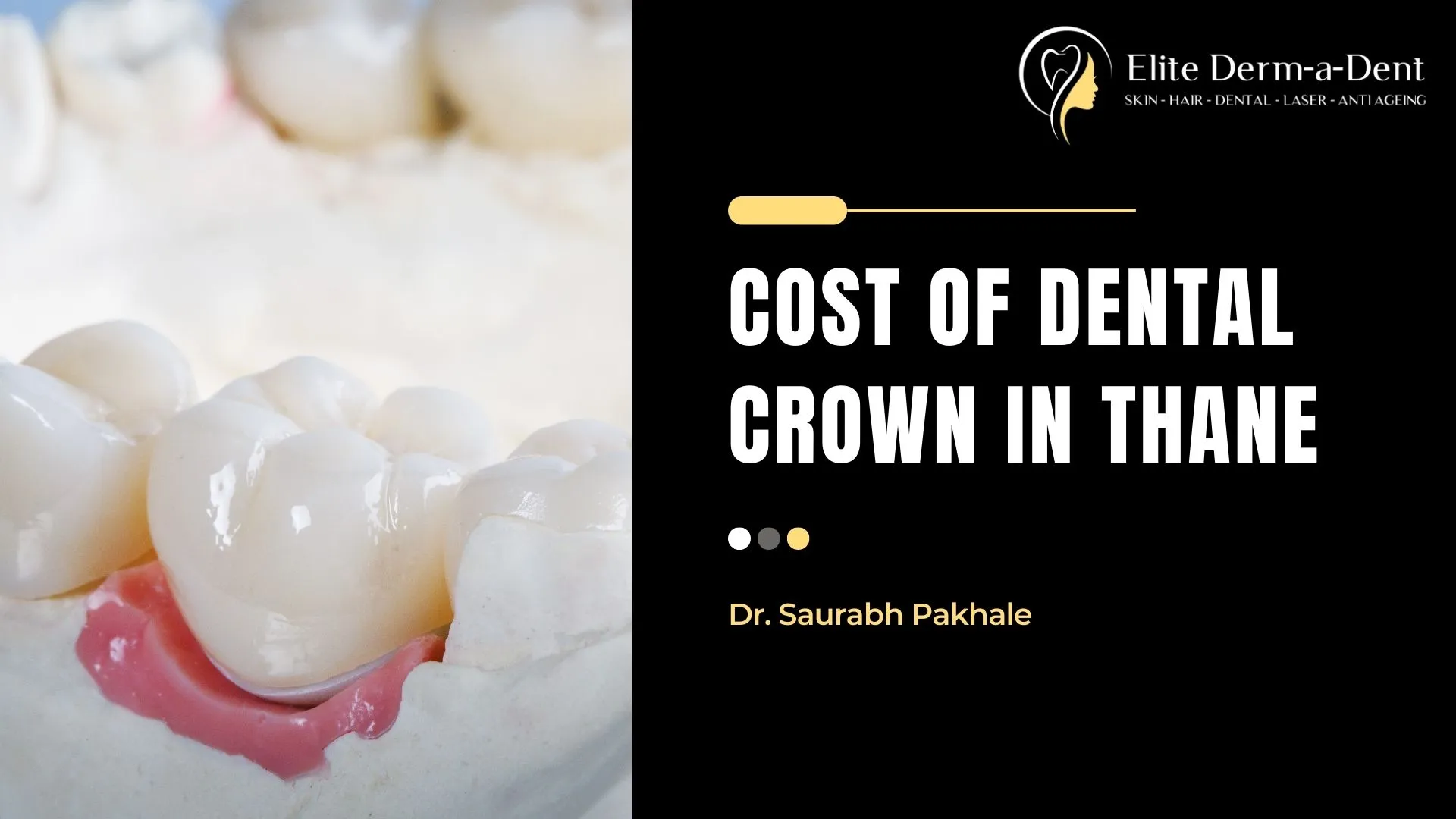 Understanding Cost of Dental Crown in Thane 2025: A Complete Guide