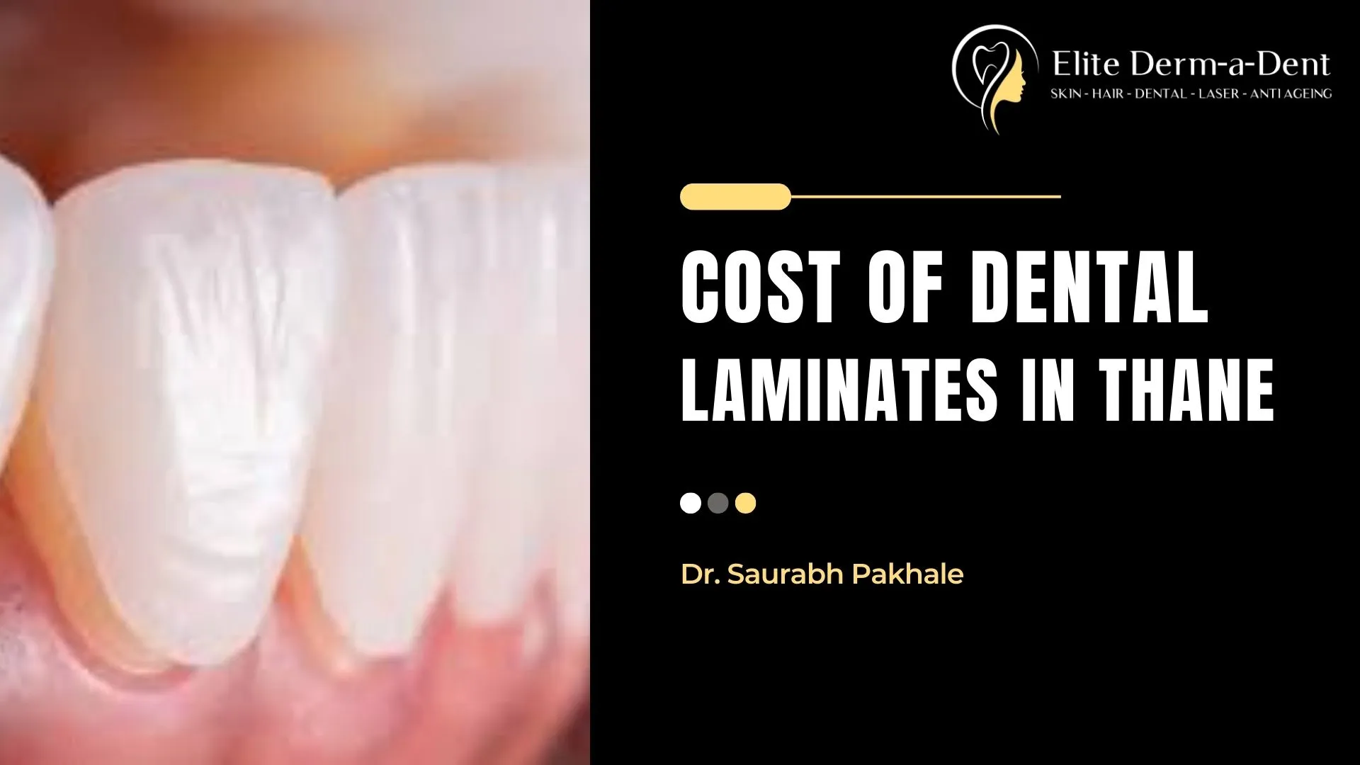 Cost of Dental Laminates in Thane