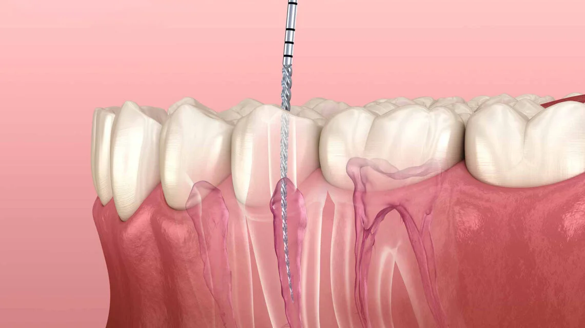 Cost of Root Canal Retreatment in Thane