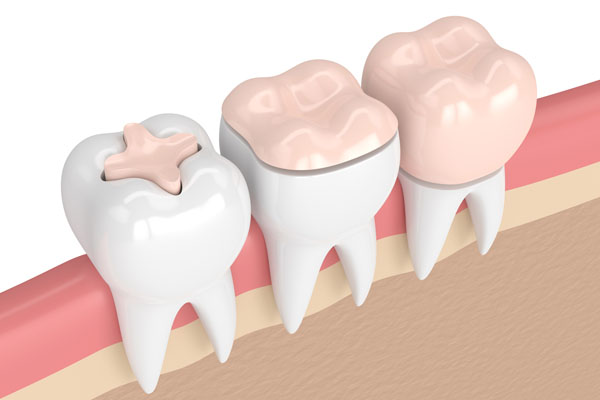 Cost of Tooth Restoration in Thane