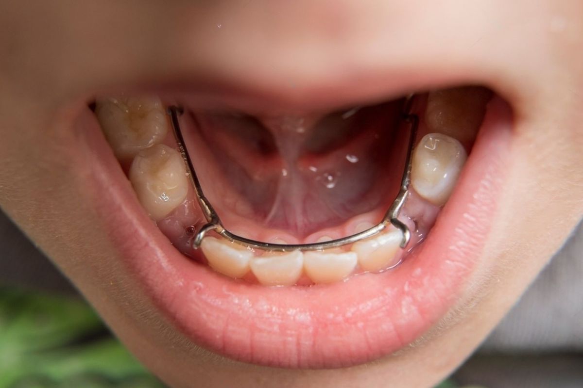Cost of Tooth Space Maintainer in Thane