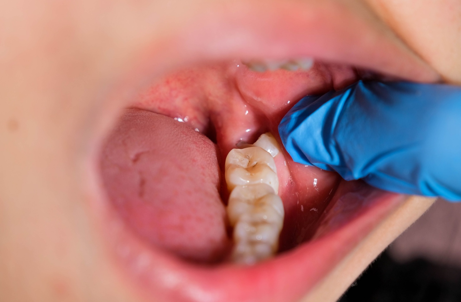 Cost of Wisdom Tooth Removal in Thane