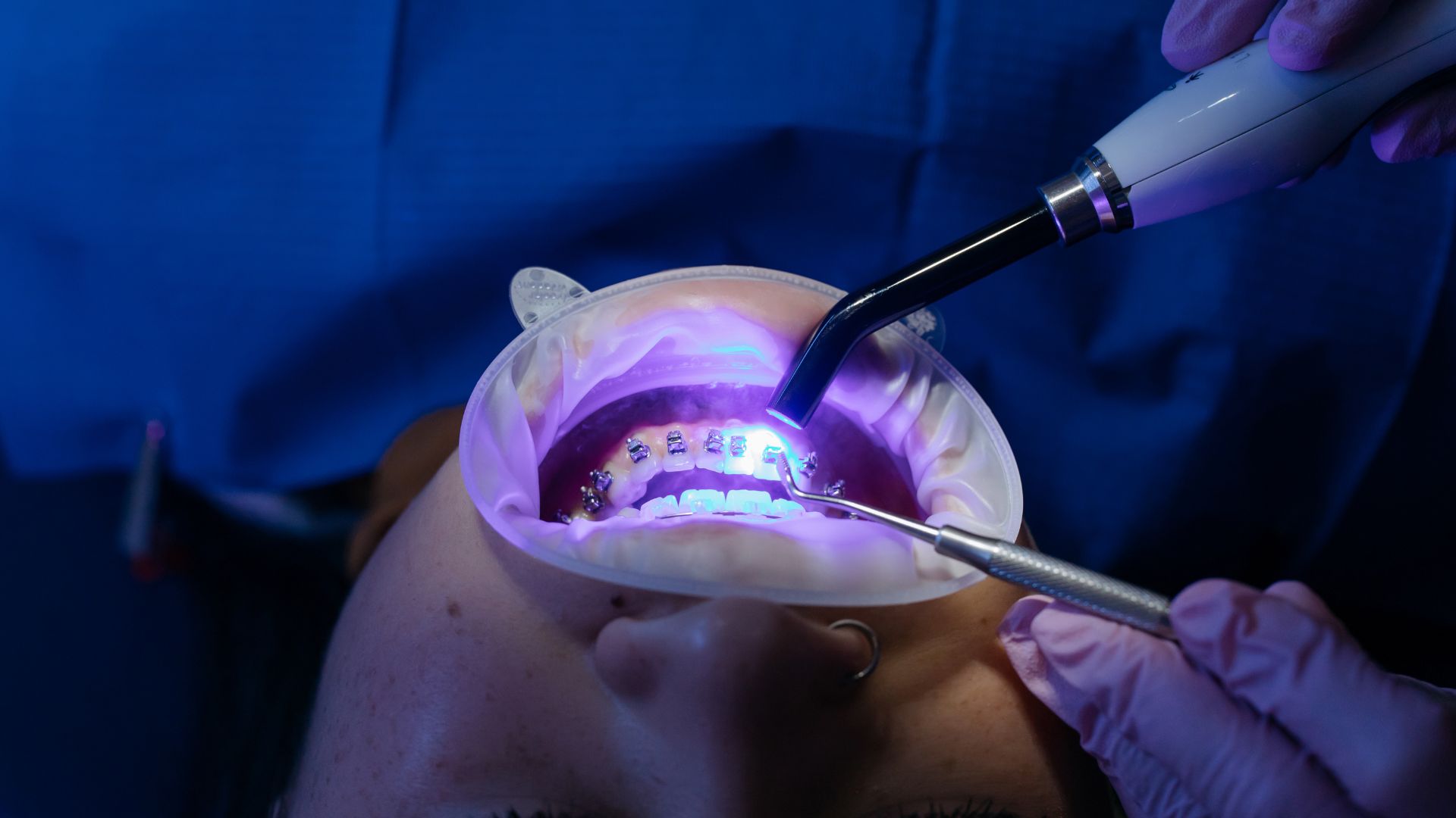 How Root Canal Performed