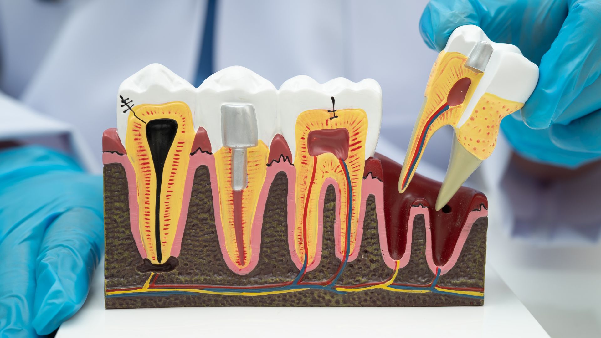 Tooth Pain Where Root Canal Is: Causes, Symptoms, and Fixes