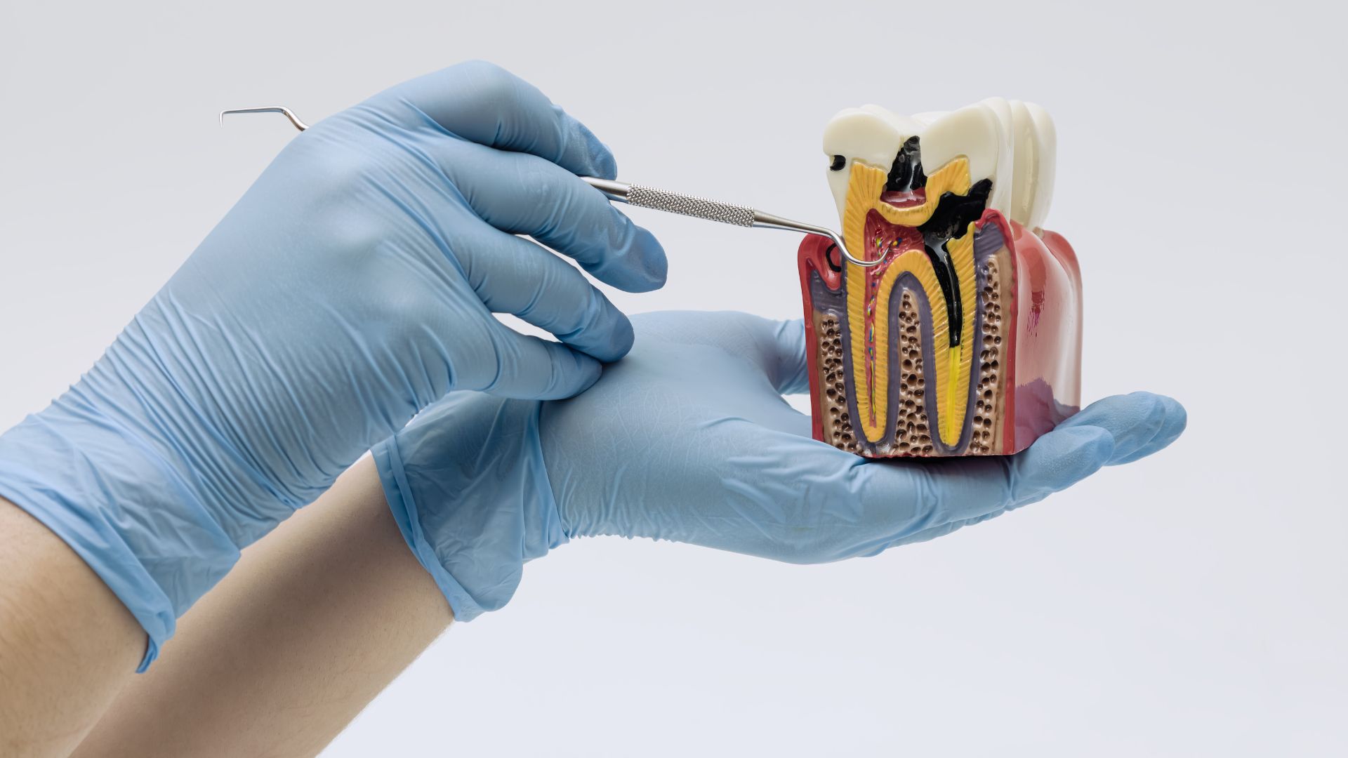 Which Root Canal Cap Is Best? 2026 Material Comparison