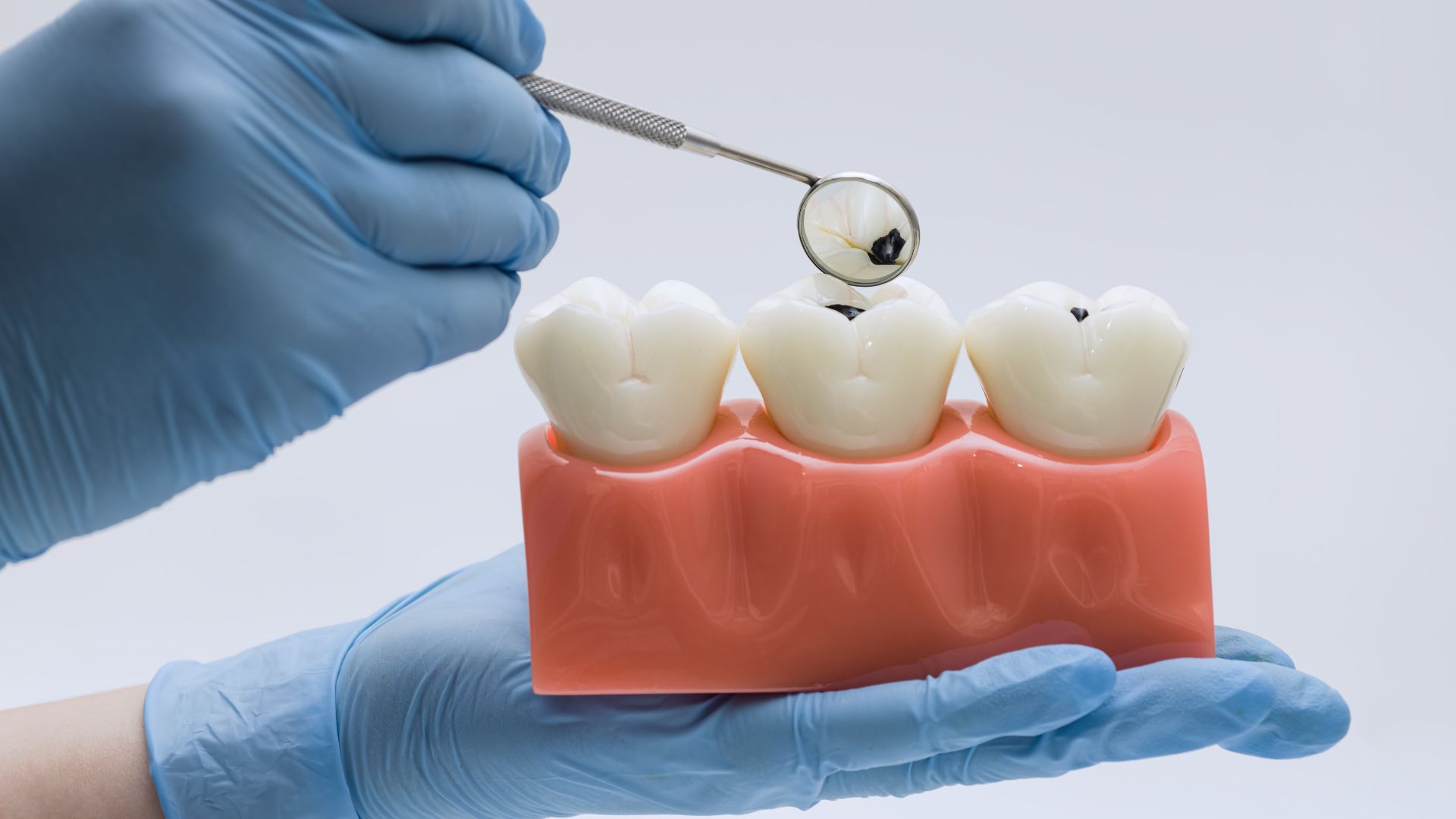 How Many Root Canals Can Be Done at Once