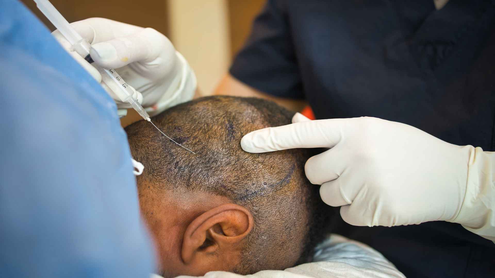 How Long Does FUE Hair Transplant Procedure Take?