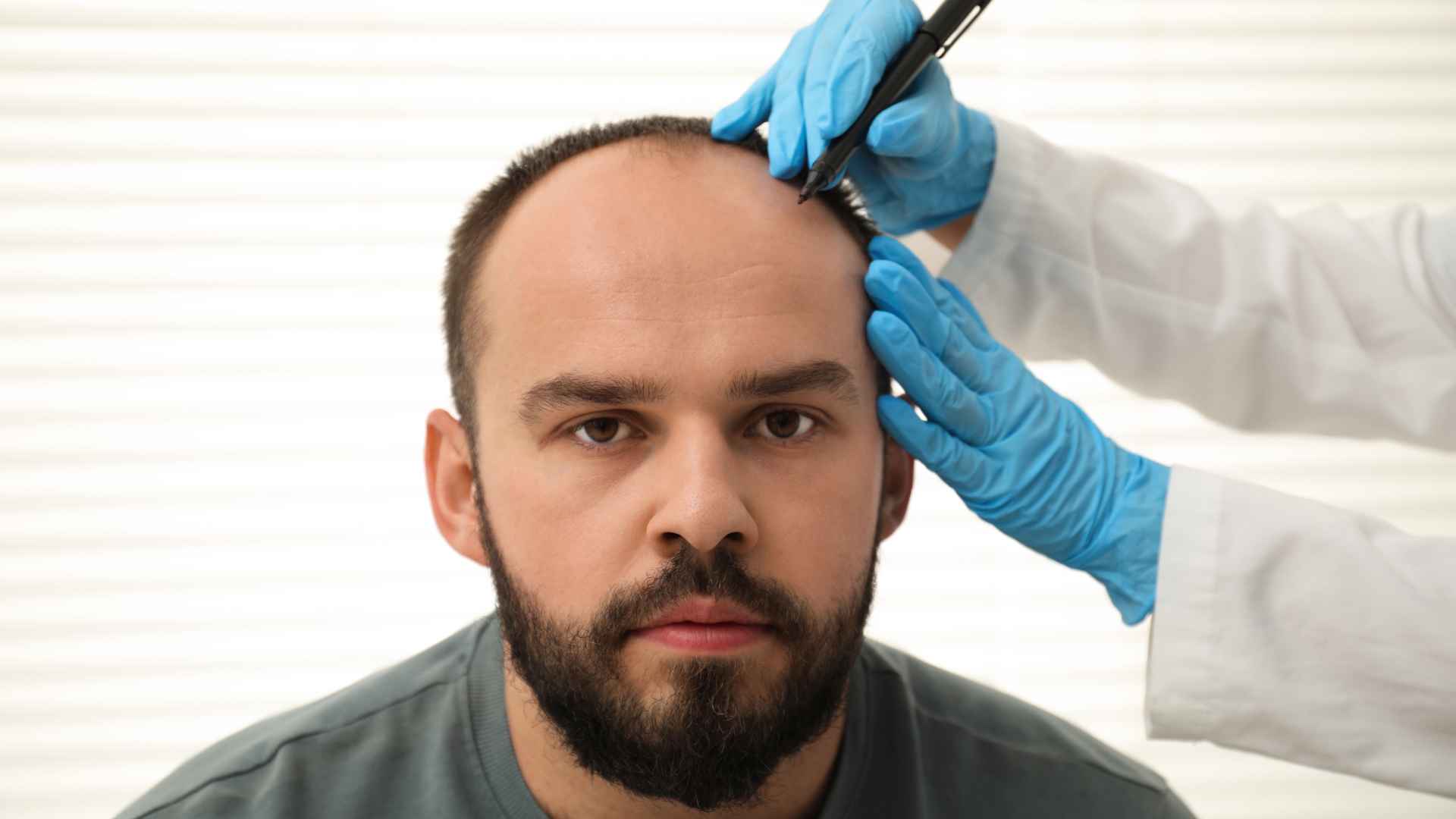 How Long Does FUE Hair Transplant Take to Grow? Month-by-Month Guide