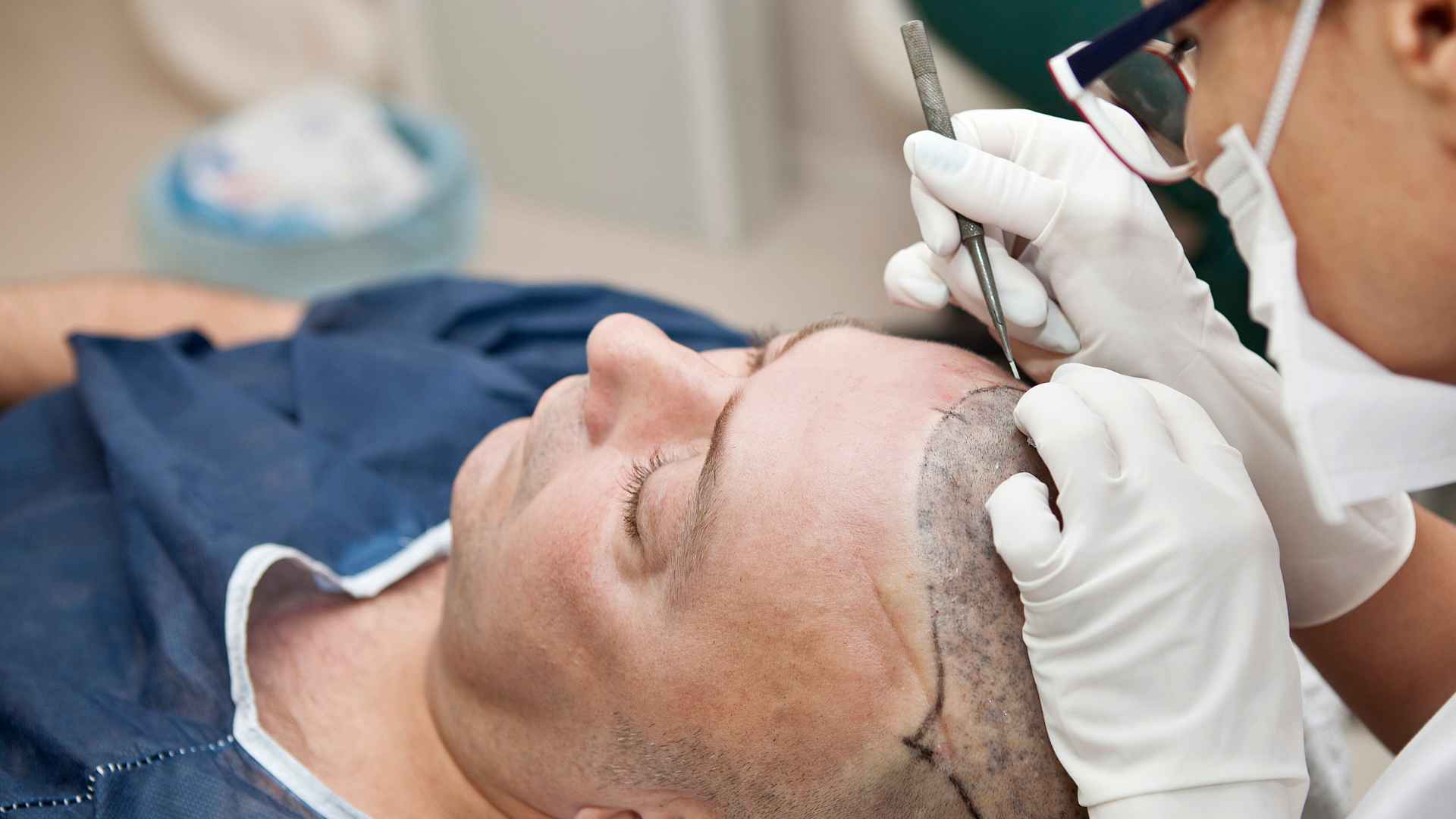 How Long After FUE Hair Transplant Can I Exercise? Safe Timeline & Rules