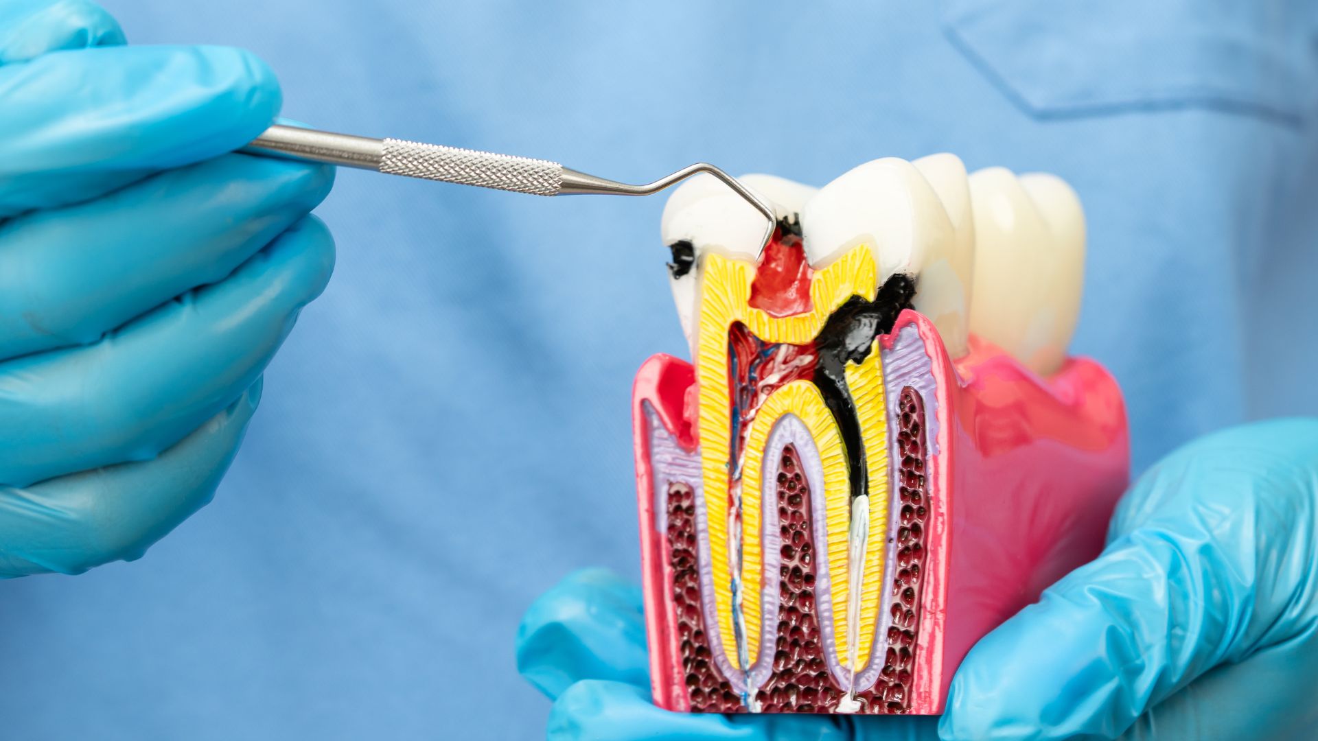 Who Does Root Canals Near Me