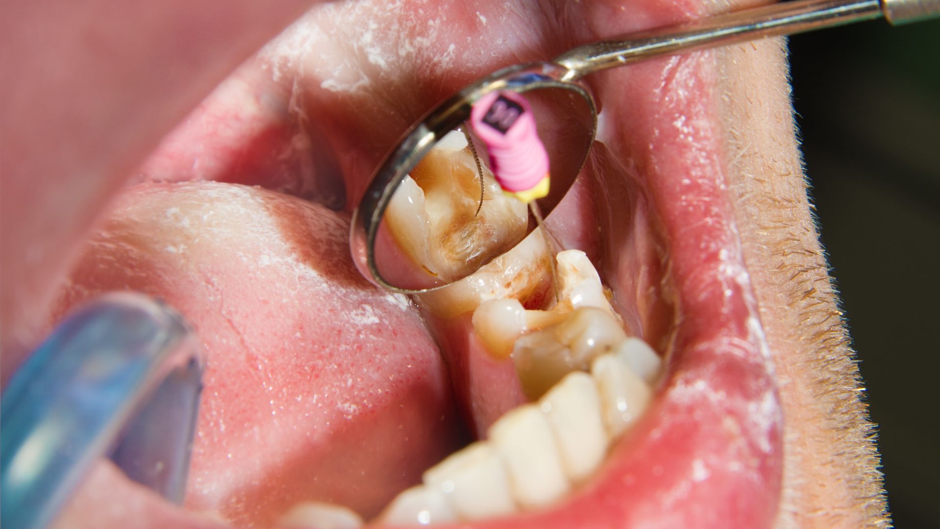 What is the Root Canal Cost in Thane